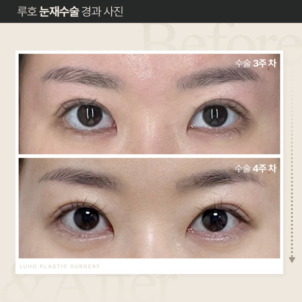 루호성형외과 눈재수술, 회복 얼마나 걸릴까? 관련 이미지 3