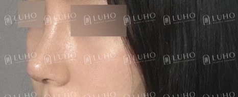 Before and After Gangnam Rhinoplasty for a Hump Nose: Refining the Prominent Hump for a New Look image 5