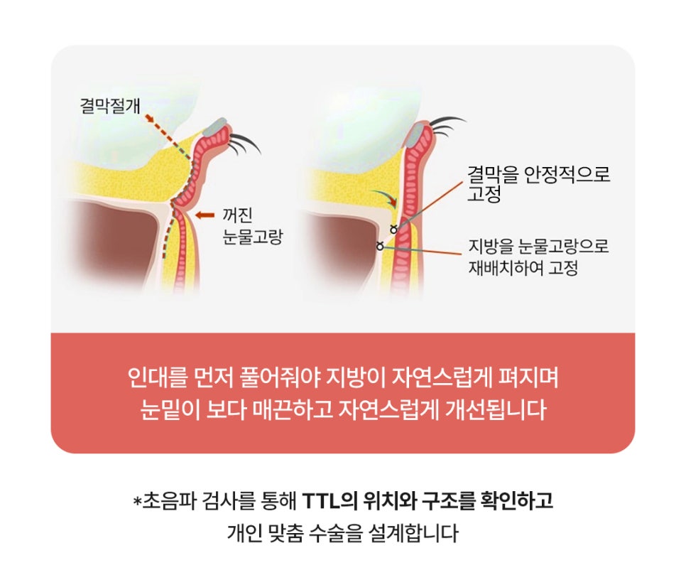 Review of Improvement to a Smooth Under-Eye Area at a Sinsa Station Under-Eye Surgery Clinic image 2