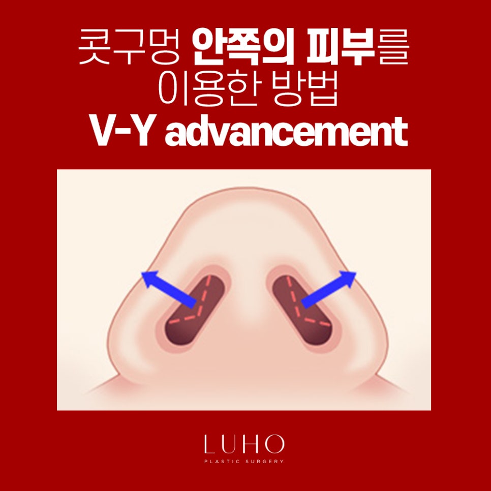 콧날개는 Down! 외모는 Up! 관련 이미지 4