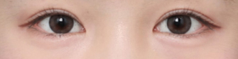 Review of Lateral and Lower Canthoplasty for Opening Up a Tight-Looking Eye Shape image 5