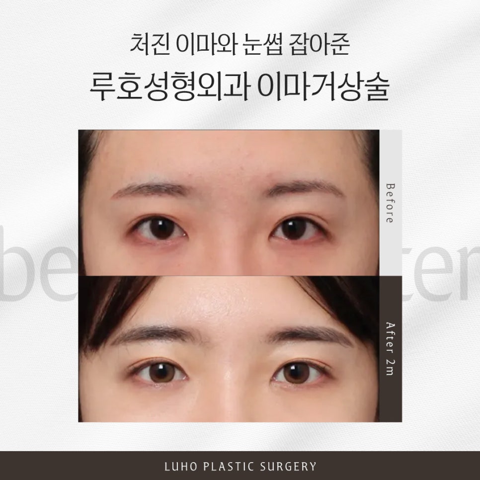 A Case of Forehead Lift Surgery in Sinsa Station That Improved Both a Drooping Forehead and Eyebrows image 1