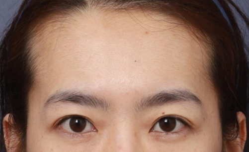 A Review of Forehead Lift Surgery at Sinsa Station That Completed a Natural Youthful Look image 3