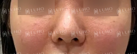 Redesigning a Bulbous Nose After 9 Years: Revision Rhinoplasty image 7