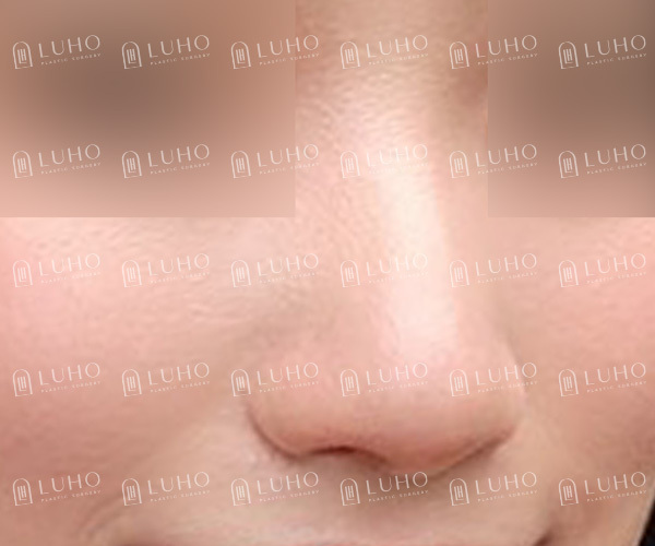 웃을 때 퍼져 보이는 코, 콧대부터 코끝까지 정리한 코수술 관련 이미지 2