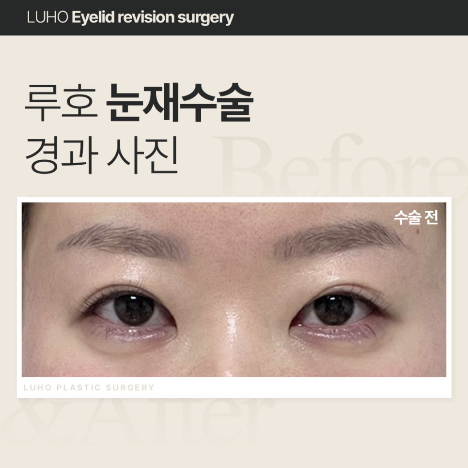 루호성형외과 눈재수술, 회복 얼마나 걸릴까? 관련 이미지 1