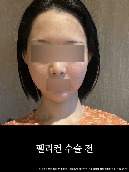 턱과 목의 경계를 찾아주는 압구정 펠리컨 수술 전후 비교 관련 이미지 2
