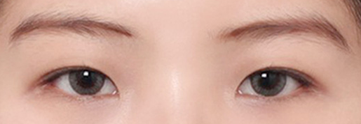 Sinnonhyeon Station Double Eyelid Revision Surgery for Faded Lines: Sharpening a Loose Line image 5