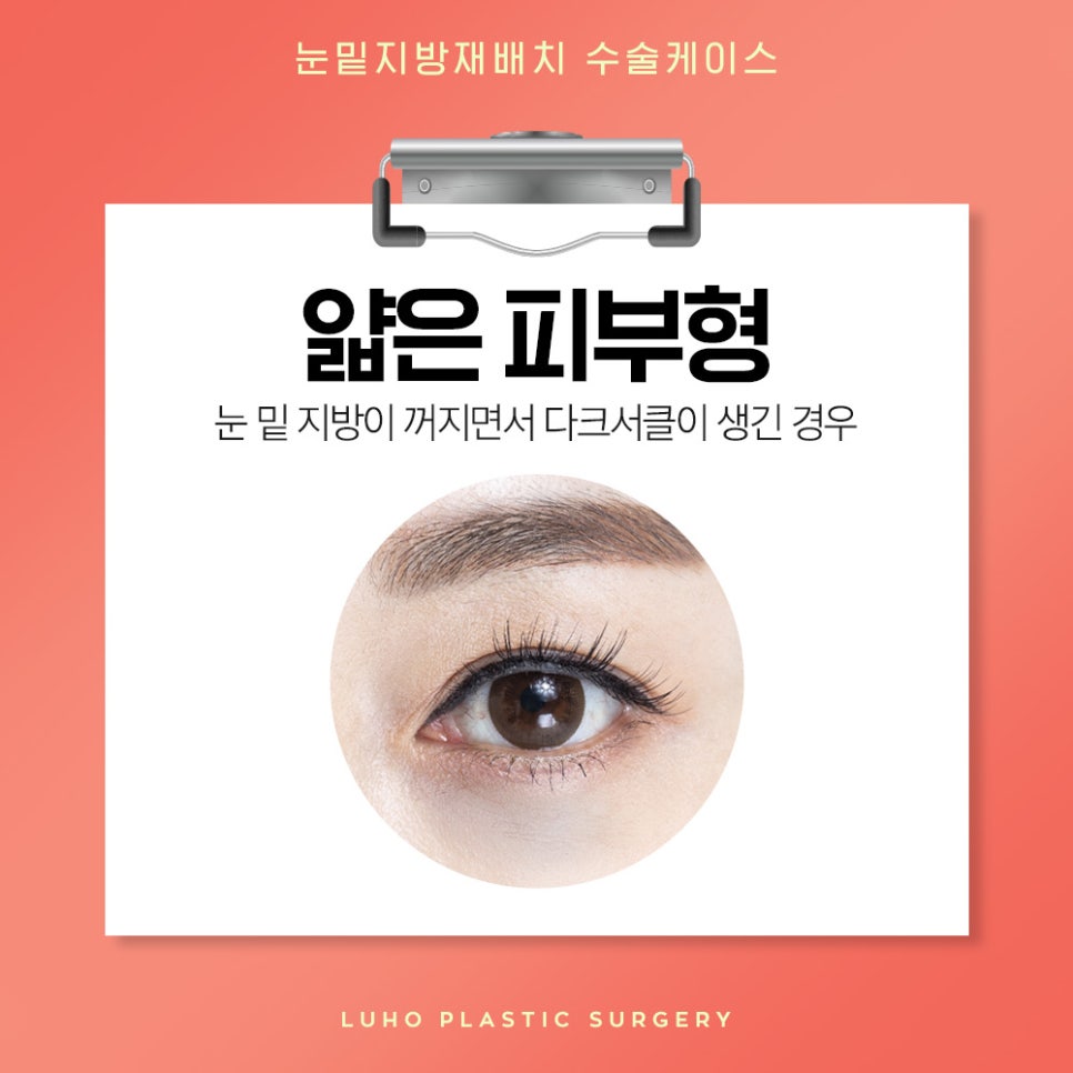 눈밑지방재배치 다크서클 개선에 효과적 관련 이미지 5