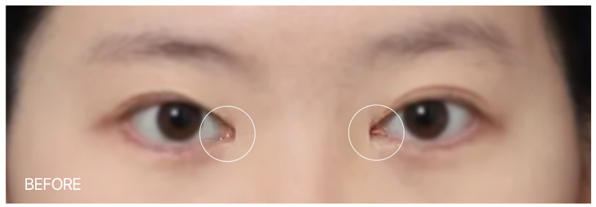 Review of Medial Canthoplasty Revision at Sinsa Station That Resolved Excessive Lacrimal Caruncle Exposure image 2