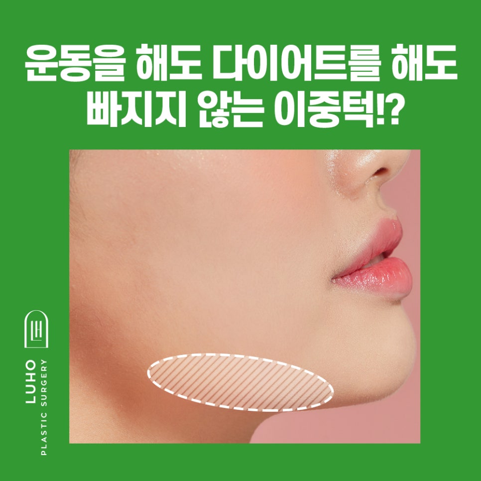 루호성형외과의 쏙 오프 지방흡입! 관련 이미지 3
