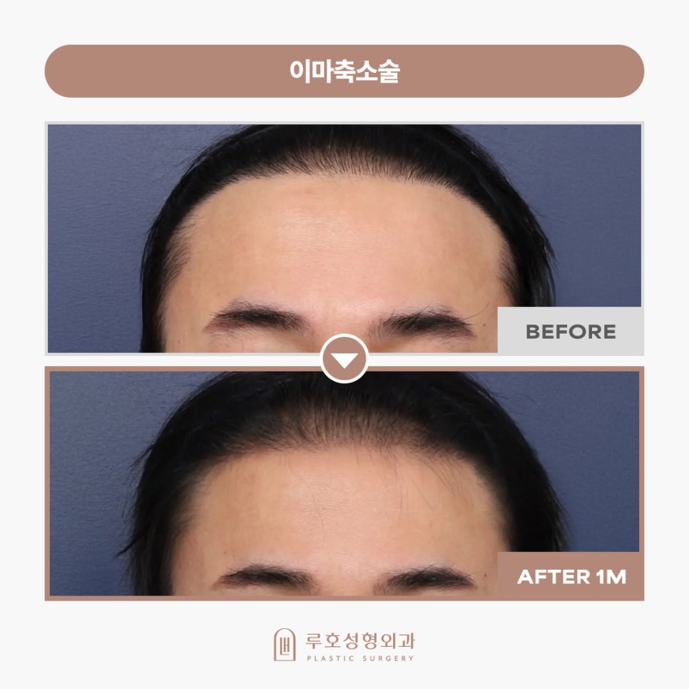Sinsa Station Forehead Reduction Surgery: Real Before-and-After Review image 3