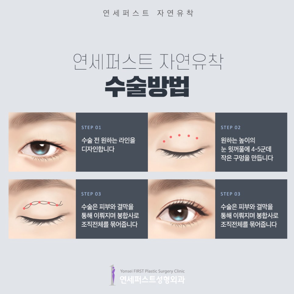 쌍꺼풀수술가격 보다 중요한것은? 자연유착으로 자연스럽게 관련 이미지 5