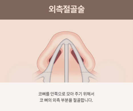 Shinsa Station Wide Nose Surgery, Center Line Neatened with Bridge Correction image 4