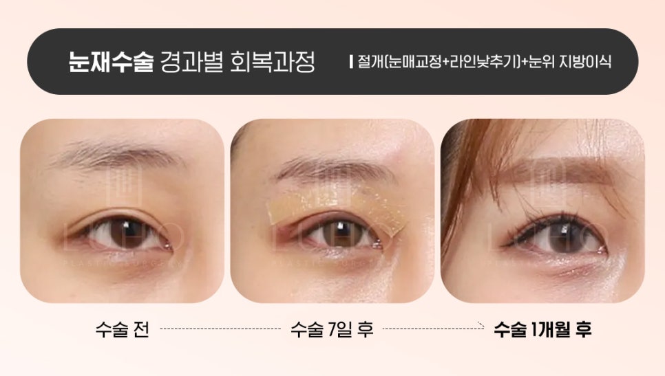 Luho Plastic Surgery Revision Eyelid Surgery Recovery Process by Stage image 5