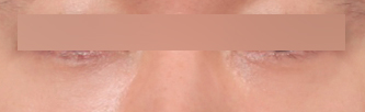 A Plastic Surgery Clinic Near Sinsa Station Specializing in Under-Eye Fat Repositioning: How to Address Under-Eye Areas That Look Like Dark Circles image 5