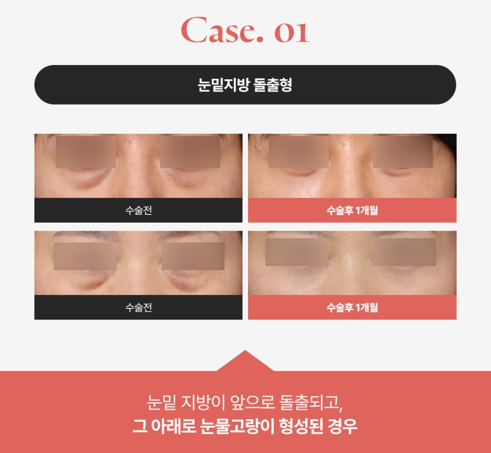 How to Get Rid of Dark Circles: A Look at Under-Eye Fat Repositioning Reviews Near Sinsa Station image 2