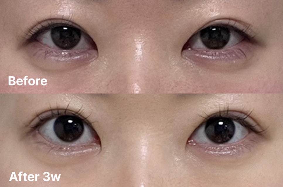 How Revision Eye Surgery Changed Uneven Eyes and a Sleepy-Looking Eye Shape image 1