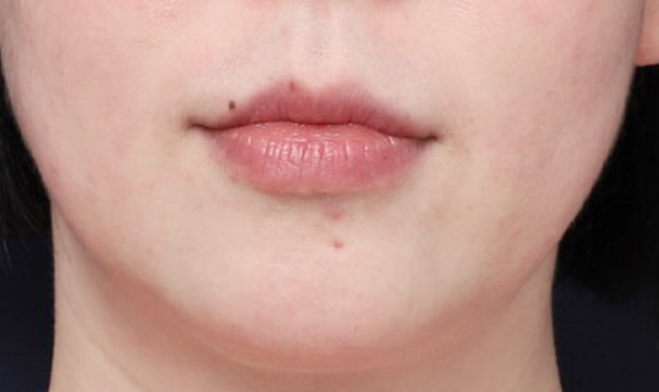 Refined Lower Face Line with Thread Lifting at Sinsa Station image 3