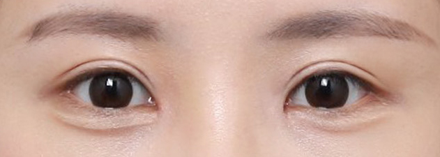 내 눈에 맞는 디자인 설계를 거친 눈재수술 후기 관련 이미지 5