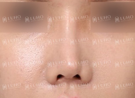 휜코를 교정하여 균형을 되찾은 코재수술 사례 관련 이미지 3