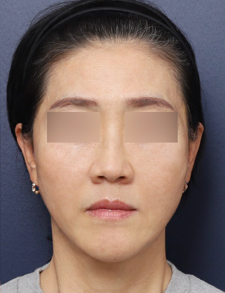 하안면 무게감을 줄인 신사역 중년 실리프팅 전후 관련 이미지 5