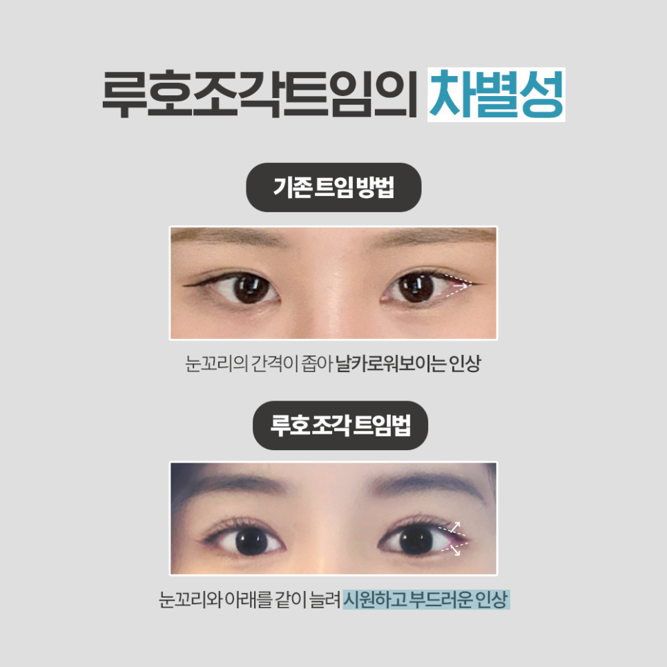 [루호성형외과] 작은 눈도 종류가 있다? 이런 분들은 꼭 트임 눈성형 하세요 관련 이미지 4