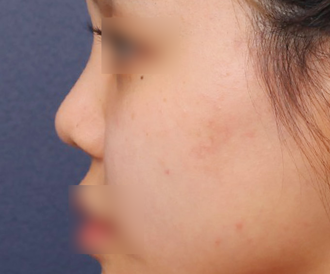 How to Address a Button Nose Based on a Surgery Review from Sinsa Station image 2