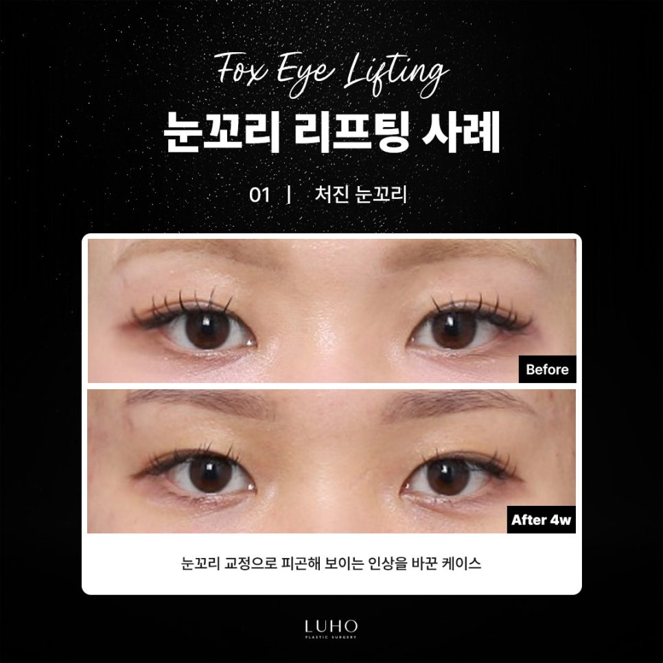 Before and After Eye-Corner Lifting in Sinsa Station for a Sharper Look Through Width Expansion image 1