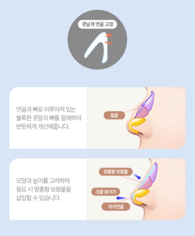 [Luho Plastic Surgery] Luho’s First Nose Surgery image 4