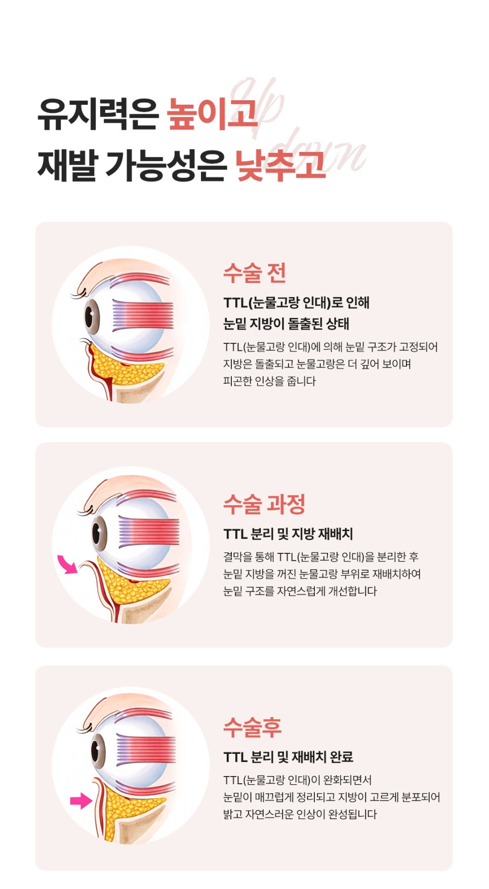 눈밑의 불룩함과 그림자를 완화해준 눈밑지방재배치 효과 관련 이미지 4