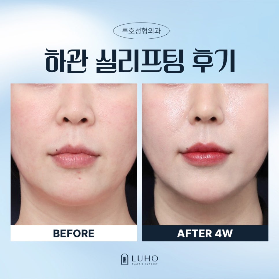 Refined Lower Face Line with Thread Lifting at Sinsa Station image 1