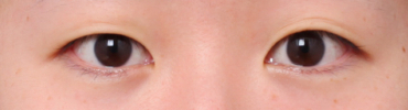 A Case of Eye Surgery Near Sinsa Station: Changed to a Natural and Defined Look image 3