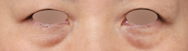 Sinsa Station Dark Circle Lower Eyelid Fat Repositioning: The Shadow Created by the Boundary Between the Under-Eye and Upper Cheek image 3