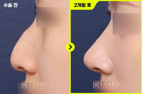 Non-Implant Rhinoplasty at Luho Plastic Surgery near Sinsa Station image 5
