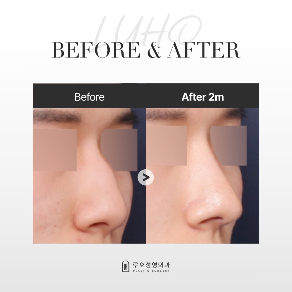 A Review of a Sinsa Station Clinic Known for Male Rhinoplasty That Created a Refined Image image 1