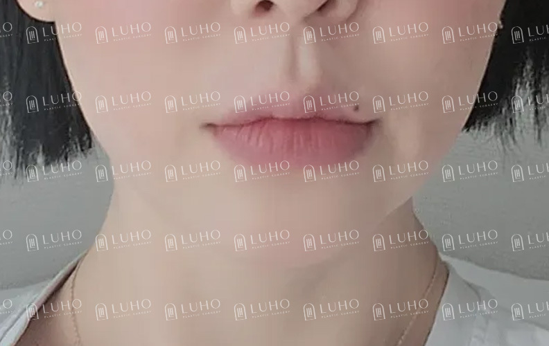 다이어트해도 안 빠지는 턱살, 이중턱 근육 묶기로 달라진 후기 관련 이미지 3