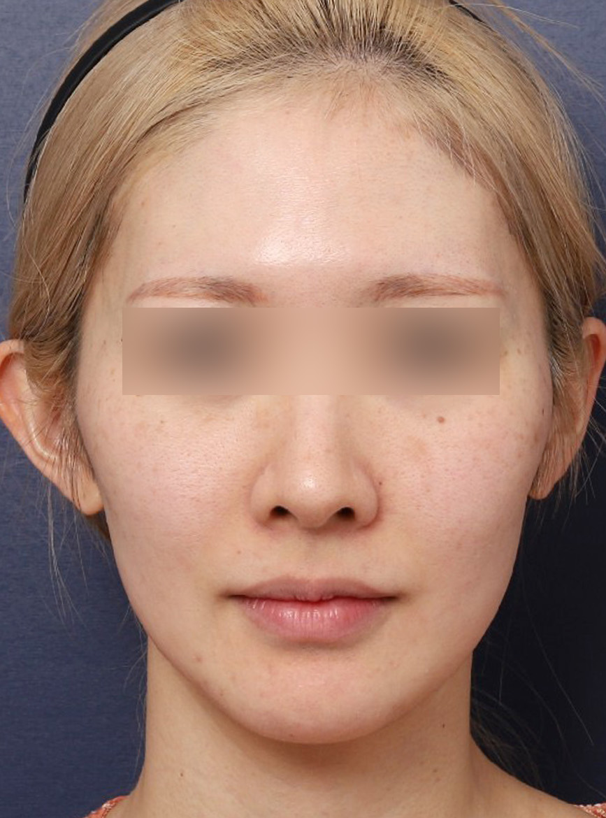 Review of Resolving Cheek Sagging with Thread Lifting Near Sinsa Station image 2