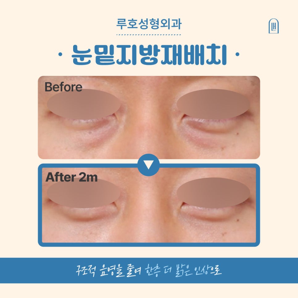 Effects of Male Under-Eye Fat Repositioning for a More Vibrant-Looking Eye Area image 1