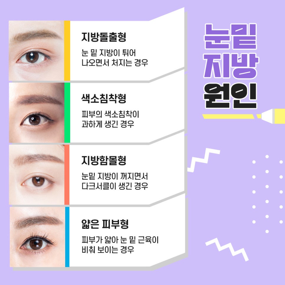 Lower Eyelid Fat Repositioning That Improves the Causes of a Tired Appearance image 2