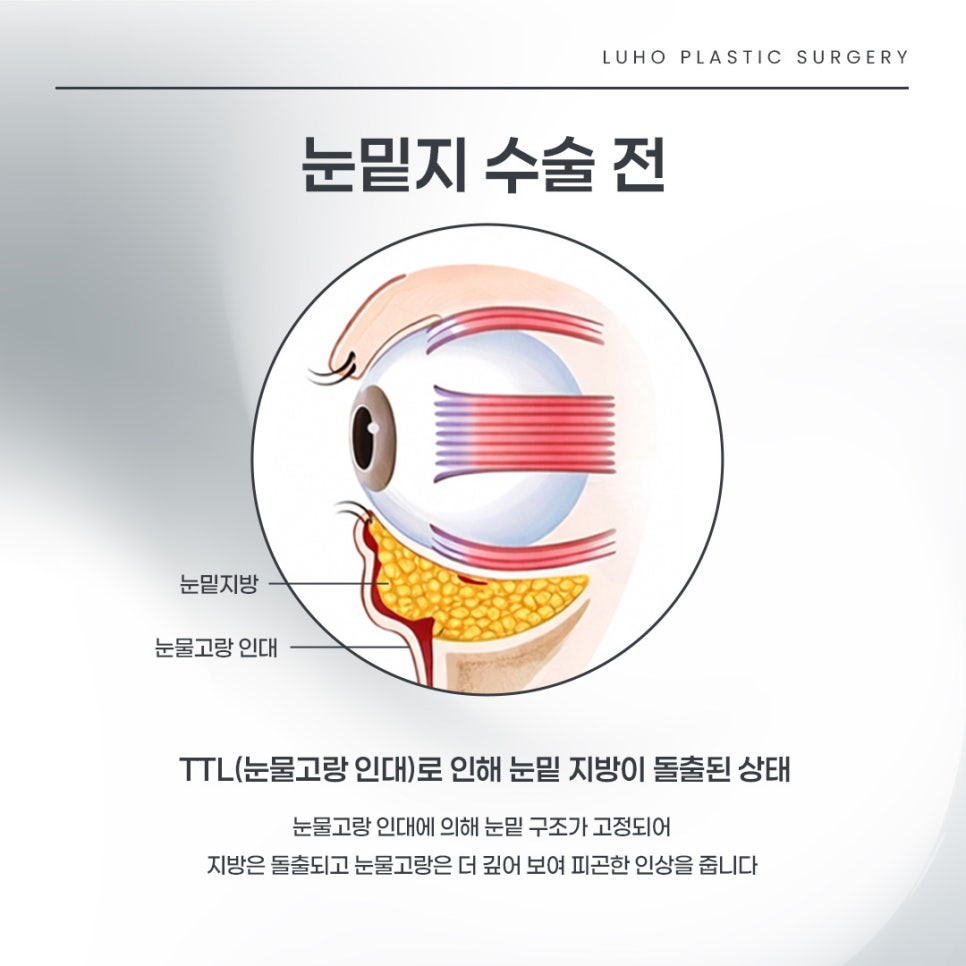 After Men’s Under-Eye Surgery at Sinsa Station That Reduced Dark Circles and Added Vitality image 2