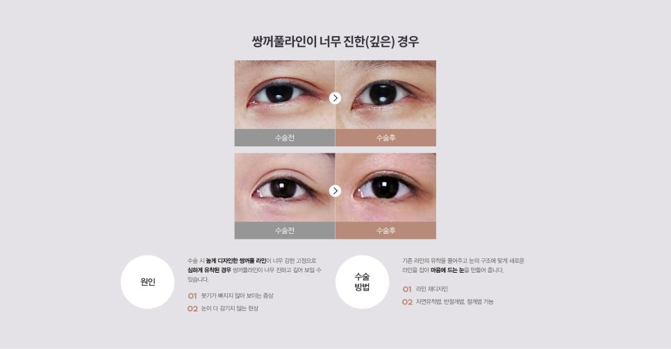 눈 수술법의 종류와 회복기간 #2 관련 이미지 8