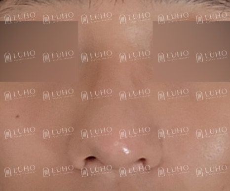 복코와 콧볼을 정리한 남자코수술, 어떤 부분이 바뀌었을까? 관련 이미지 5