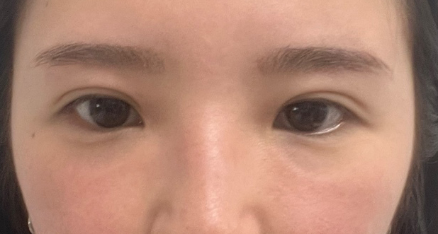 A Review of Shinsegae Station Under-Eye Fat Repositioning to Improve Dark Shadows Under the Eyes image 2