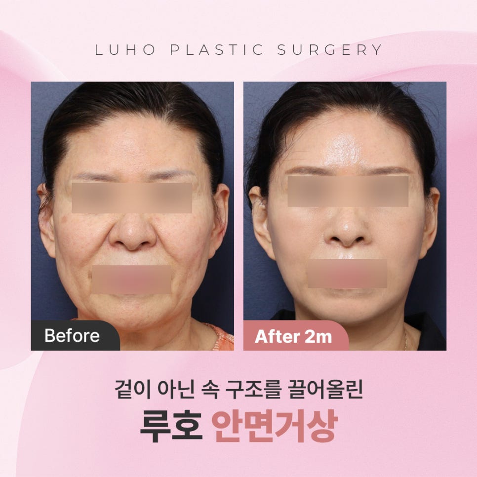 신사역 60대 안면거상 피부가 아닌 관련 이미지 1