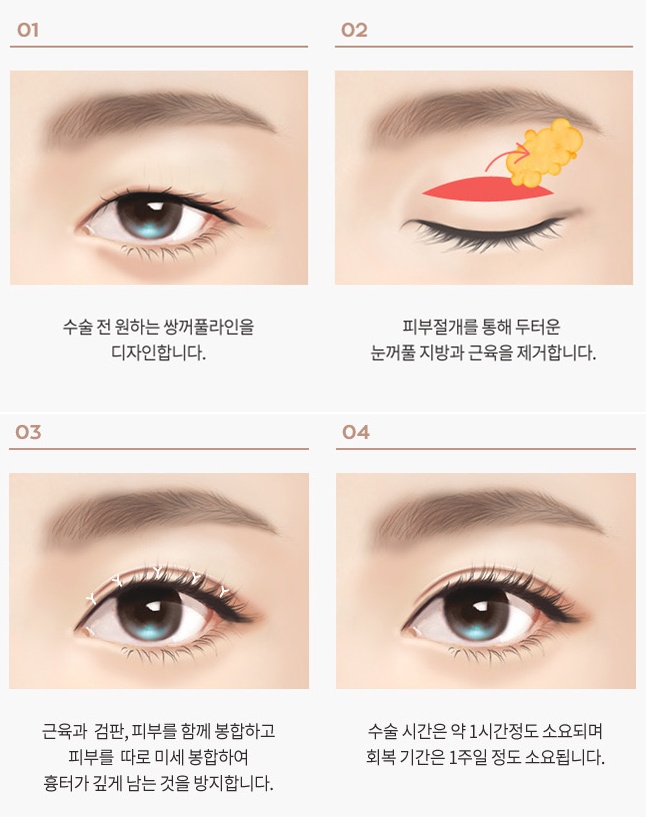 Incisional Double Eyelid Surgery Near Nonhyeon Station: Which Eyes Is It Good For? image 3