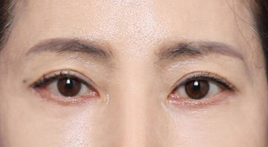 처진 눈매 흐름을 바꿔준 신사역 눈꼬리 실리프팅 관련 이미지 5