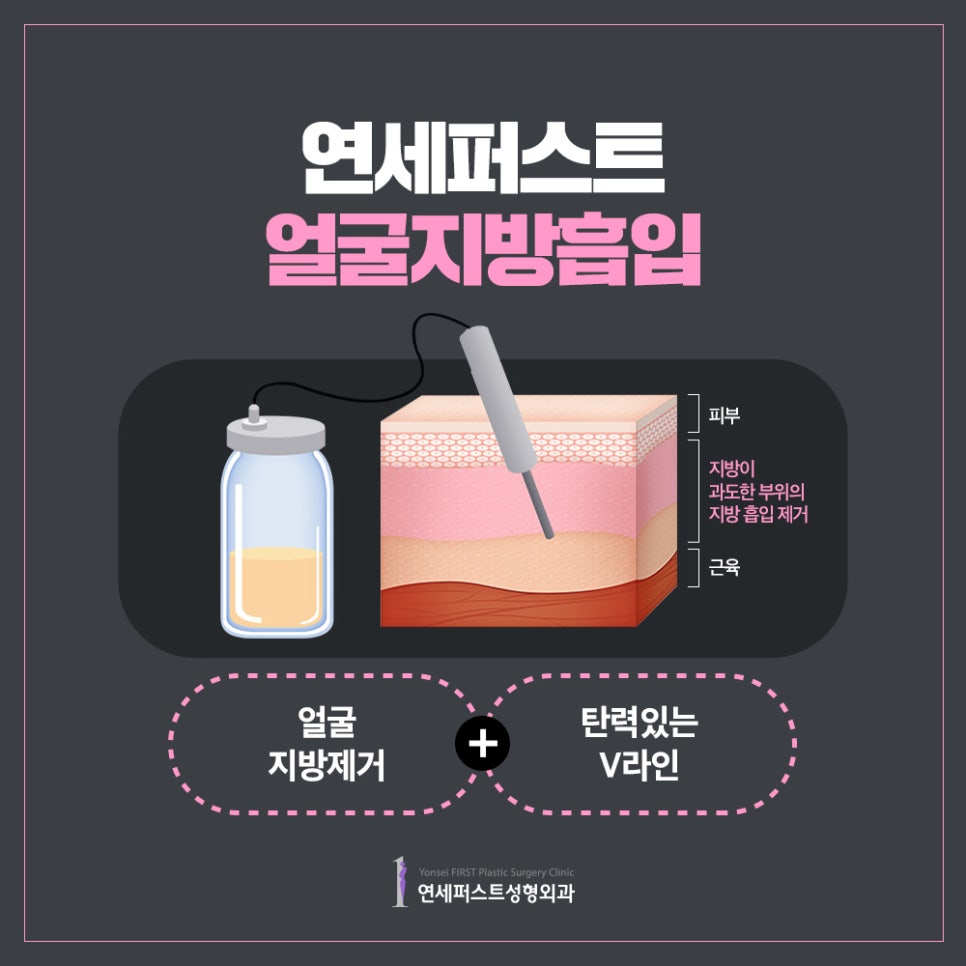 얼굴지방흡입비용 알아본다면? 관련 이미지 4