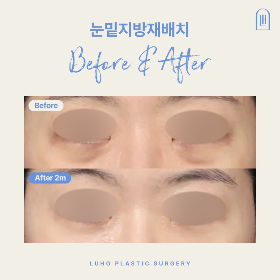 Sinsa Station Under-Eye Fat Repositioning Clinic: Dark Circles + Review of Improvement for Uneven Under-Eyes image 1