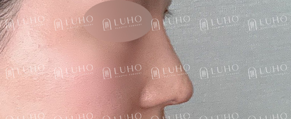 낮은 콧대와 둥근 코끝, 자연스럽게 정리한 코수술 전후 관련 이미지 5